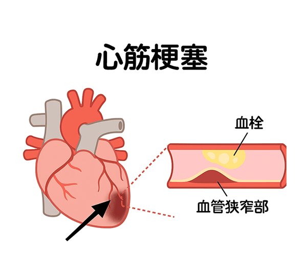 心筋梗塞